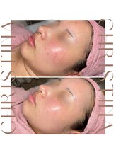 ティセラ(TISERA.)/【施術前後】赤み/ニキビケア