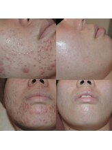 ホワイトアクア 天王寺本店(WHITE AQUA)/ハーブピーリング/大阪/天王寺