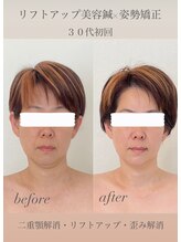 めい鍼灸院/リフトアップ美容鍼