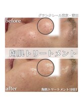 グランクレール トウキョウ(GRANDCLAIRE.TOKYO)/陶肌トリートメント