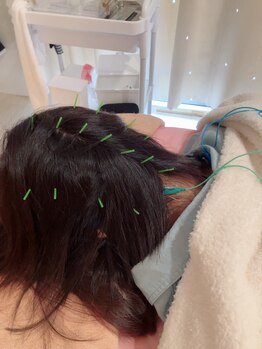 瑞 鍼灸院/頭皮鍼+美容鍼