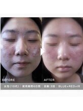 ティアーナ(Tiaana)/LED　３回