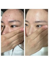 ベル(BELL)/肌荒れにお悩み