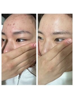 ベル(BELL)/肌荒れにお悩み