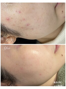 プレローマ(Pleroma)の写真/自然に美しい肌へ◎根本から肌質改善したい方に。国産ハーブ・天然成分が肌内部まで働きかけ◎剥離なし♪