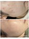 プレローマ(Pleroma)の写真/自然に美しい肌へ◎根本から肌質改善したい方に。国産ハーブ・天然成分が肌内部まで働きかけ◎剥離なし♪
