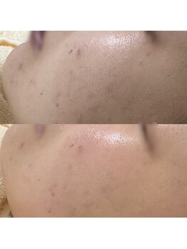 ハーナウ ハウ(hanau hou)/ハーブピーリング効果