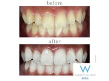 ホワイトニングショップ 新潟店/ホワイトニングビフォーアフター