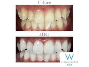 ホワイトニングショップ 新潟店/ホワイトニングビフォーアフター