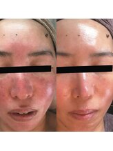 ホワイトアクア 天王寺本店(WHITE AQUA)/ララピール/大阪/天王寺/小顔