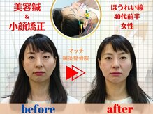 マッチ鍼灸整骨院/ほうれい線対策は美容鍼＆小顔