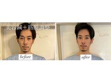 ヤマモト 表参道院(YAMAMOTO)/美容鍼＋筋膜調整　メンズ美容鍼