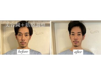 ヤマモト 表参道院(YAMAMOTO)/美容鍼＋筋膜調整　メンズ美容鍼