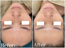 サロンドフェイス(Salon de Faith)/ハーブピーリング