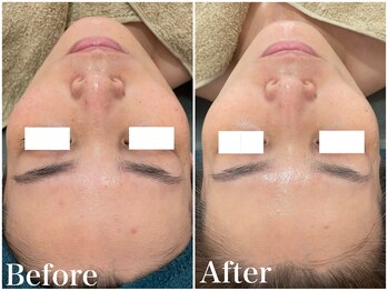 サロンドフェイス(Salon de Faith)/ハーブピーリング