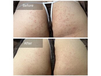 ルナート(Lunart)/ハーブピーリング【でん部】