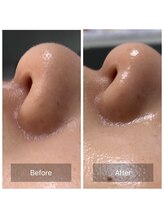 ビジュープラス 筑西下館店(Bijou+)/【30代お悩み】たるみ毛穴/初回