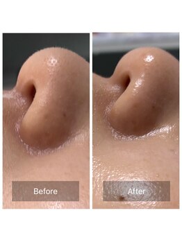 ビジュープラス 筑西下館店(Bijou+)/【30代お悩み】たるみ毛穴/初回