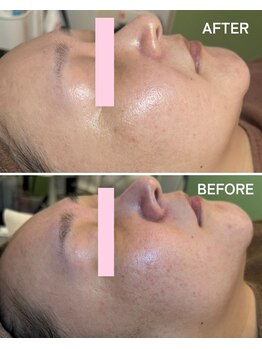 ギルドハナレ(GUILD HANARE)/"美肌に改善"