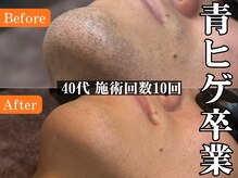 before＆afterはフォトギャラリーをご参照ください！！#ヒゲ脱毛
