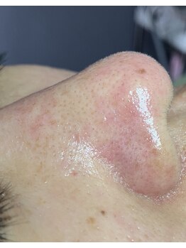 リンカ(Rinca)/毛穴エクストラクション最高！