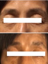 長寿鍼灸院 長寿整骨院/美容鍼50本の効果★目元ケア