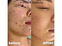 ユアーズ ビューティー(YOURS beauty)/棘あり☆１回