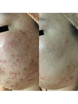 ホワイトアクア 天王寺本店(WHITE AQUA)/ハーブピーリング/大阪/天王寺