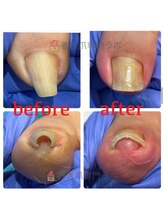 巻き爪専門ラボ 豊田店/巻き爪