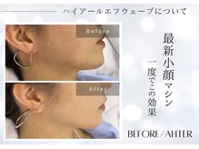 ユアーズ ビューティー(YOURS beauty)/1回で驚きの小顔へ☆