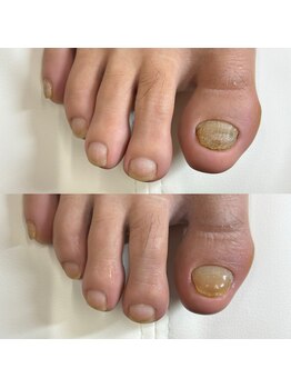 リリ(lili)/巻き爪矯正&ネイルケア/1回目