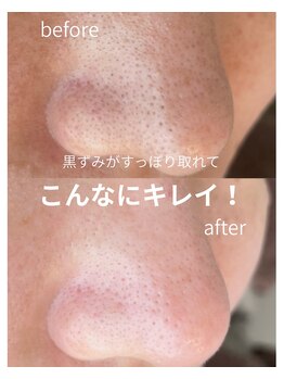 シアン(CYAN)/【毛穴】ビフォー/アフター