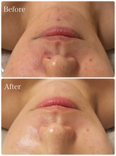 ロイヤル(ROYAL)/トロイハーブピーリング