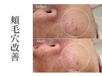 エトレ(etre)/毛穴改善/強炭酸/ピーリング