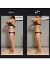 エヌボーテ(N. beaute)/before→after全身コース三回目