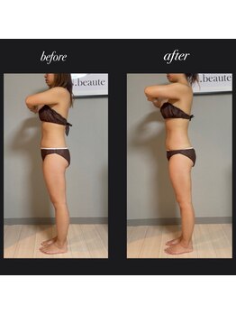 エヌボーテ(N. beaute)/before→after全身コース三回目