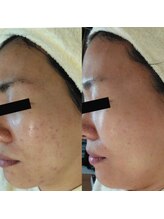 ホワイトアクア 天王寺本店(WHITE AQUA)/ララピール/大阪/天王寺/毛穴