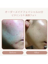 プリマジュール/ニキビケア（オーダーメイドF）