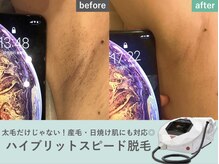 アネラ 新宿店(ANELA)の雰囲気（美肌に導くフォト脱毛でムダ毛もお肌のお悩みも一気に解消♪）