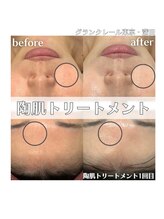 グランクレール トウキョウ(GRANDCLAIRE.TOKYO)/陶肌トリートメント