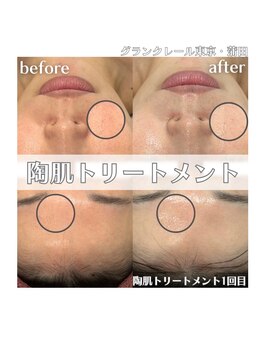 グランクレール トウキョウ(GRANDCLAIRE.TOKYO)/陶肌トリートメント