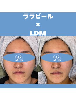 リスキン(Reskin)/《ツヤ、リフトアップ》