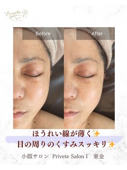 アイ(I)/ほうれい線と目の周りスッキリ！
