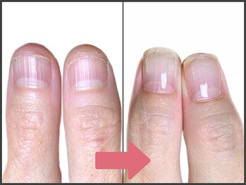 アモ 坂戸(’Amo)/深爪矯正・自爪育成 坂戸/北坂戸