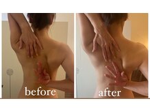 カムズ ビューティー(COMES BEAUTY)/肩甲骨ビフォーアフター