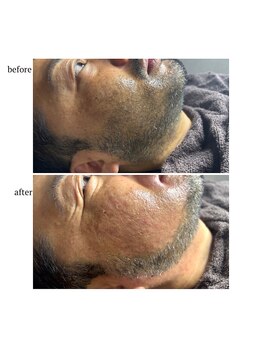 リムエス 札幌(limEss.)/商材【脱毛/ワックス脱毛】