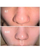 ミニョン(mignon)/お顔の弛みは、、、