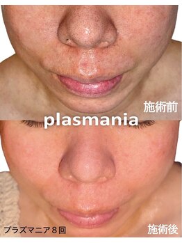 アールスタイルビューティ(R STYLE BEAUTY)/プラズマハ-ブピ-リング赤ニキビ