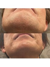 フェリーバ(FELIVA)/お髭も体毛もおか任せください