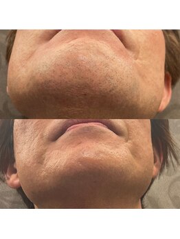 フェリーバ(FELIVA)/お髭も体毛もおか任せください